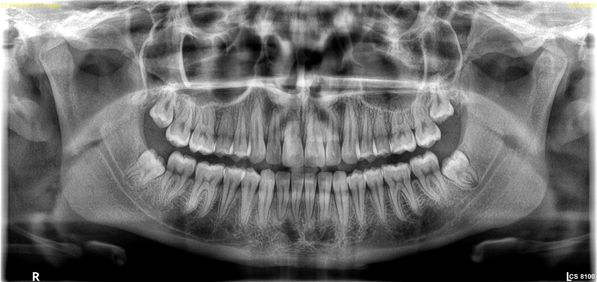Ortopantomografía Carestream CS 8100 con tecnología Tomosharp